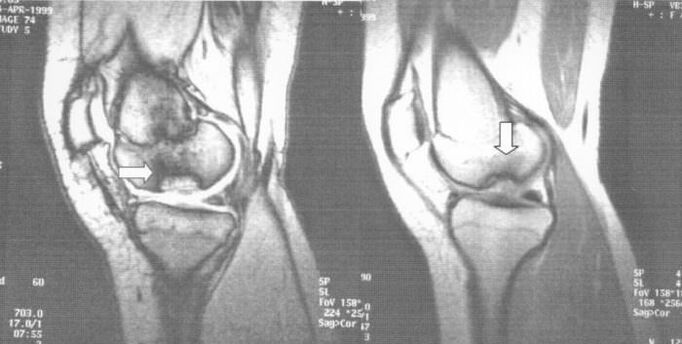 radiografía de osteocondrose disecante na articulación do xeonllo