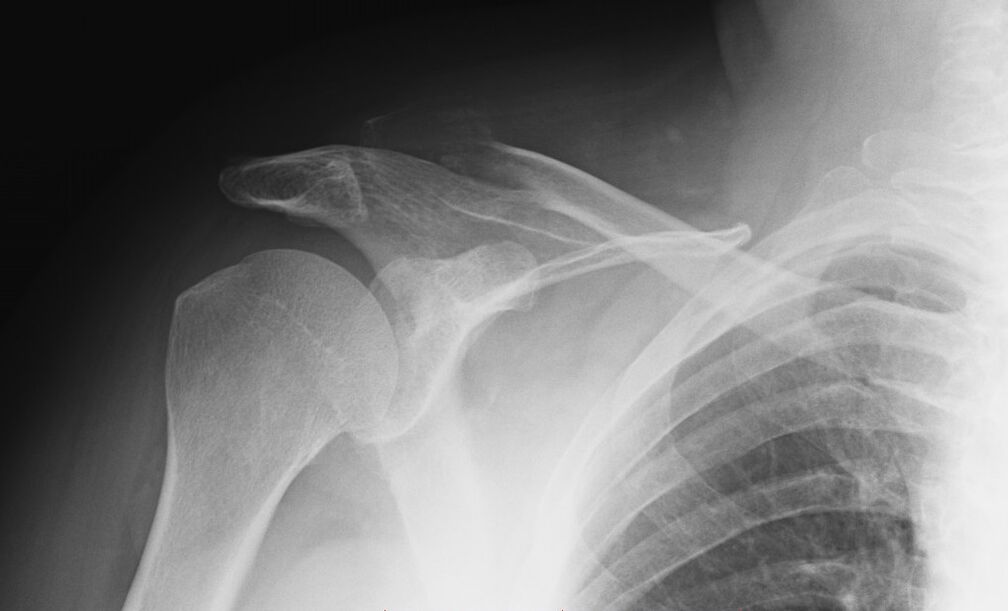 radiografía de artrose do ombreiro