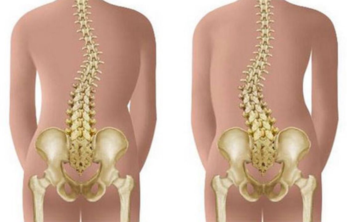 escoliose como causa de dor nas costas na zona dos omóplatos