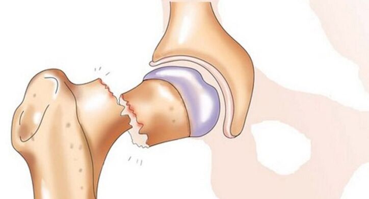 A fractura do pescozo femoral vai acompañada de dor intensa na articulación da cadeira