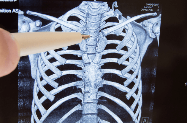 Osteocondrose