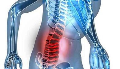Sinais e síntomas da osteocondrose lumbar